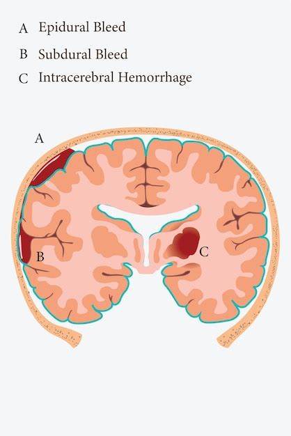 Ilustrace znázorňující různé typy poškození vozidla.