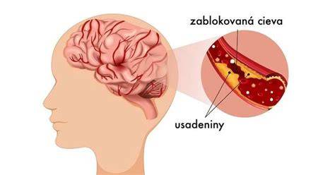 Obrázok s usadeninami v ostřikovačích a pohyblivým válečkem